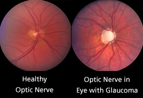 optic-nerve-comparison_290
